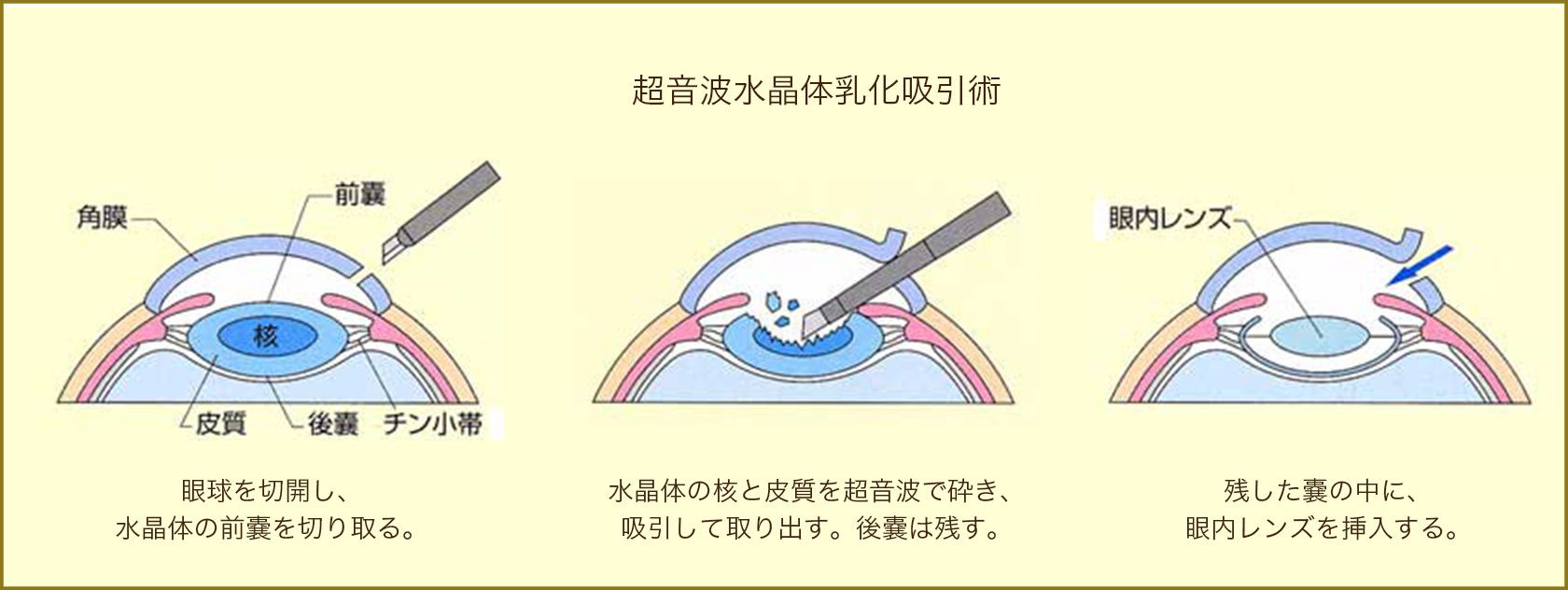 手術の実際