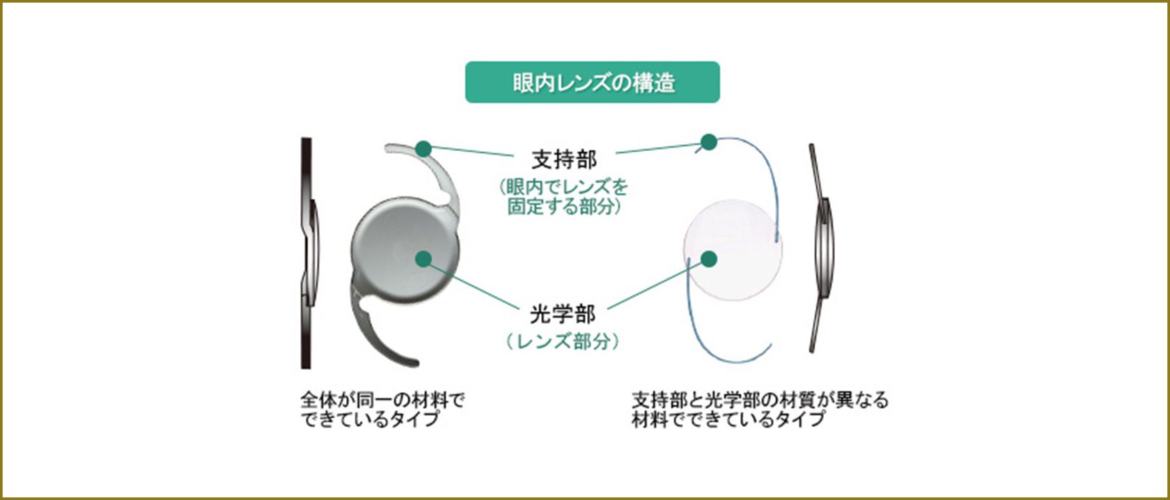 眼内レンズ