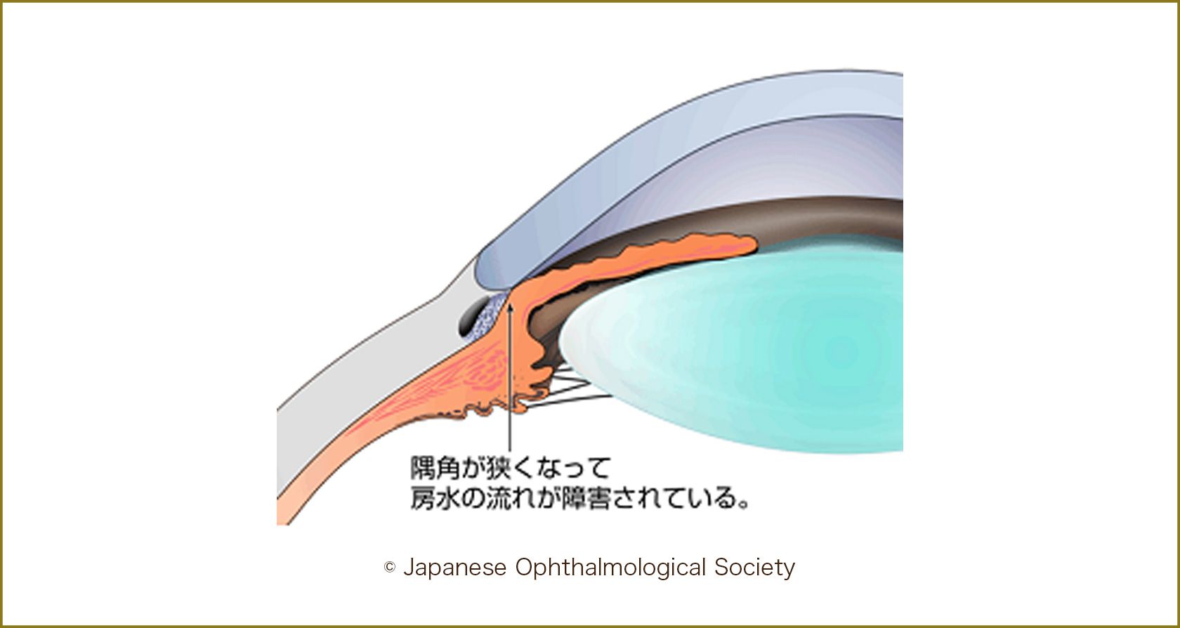 閉塞隅角眼