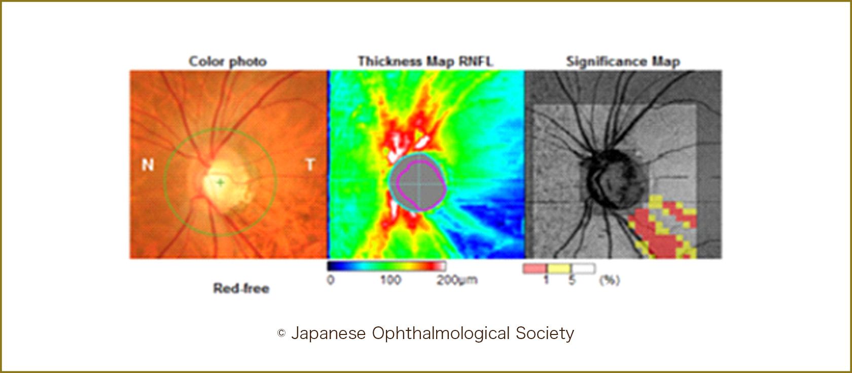 OCTによる視神経線維欠損の測定