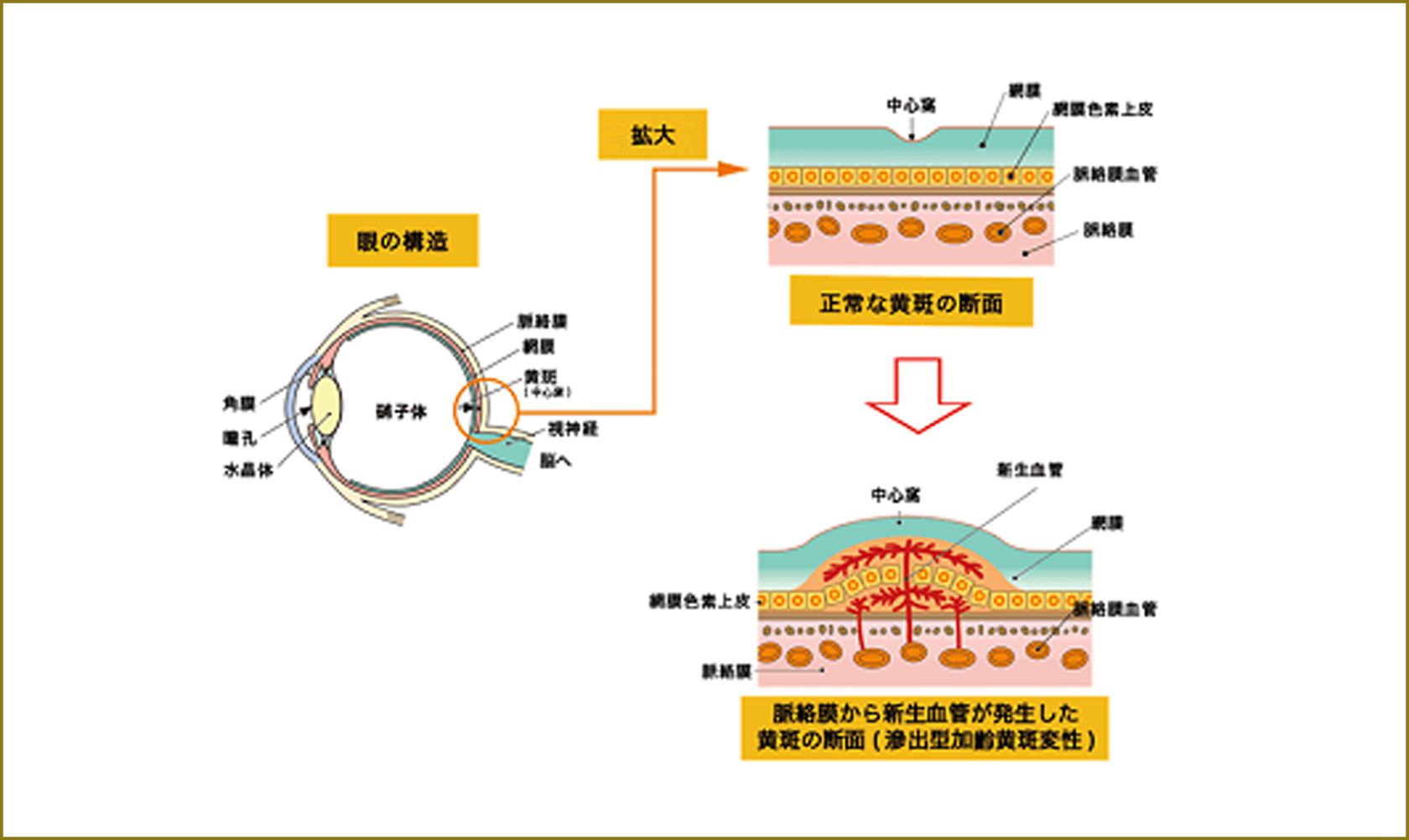 脈絡膜新生血管