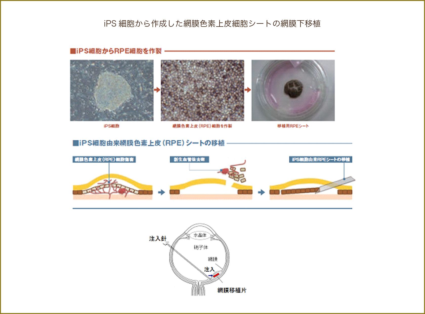 iPS細胞から作成した網膜色素上皮細胞シートの網膜下移植