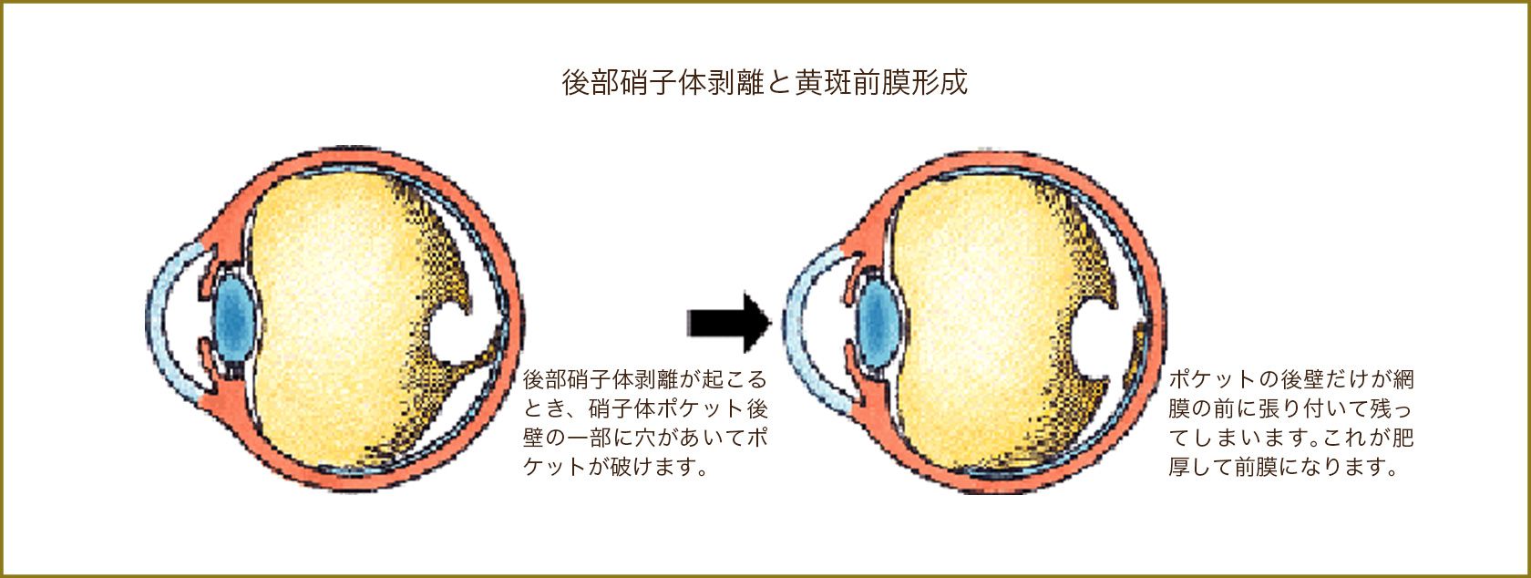 後部硝子体剥離と黄斑前膜形成