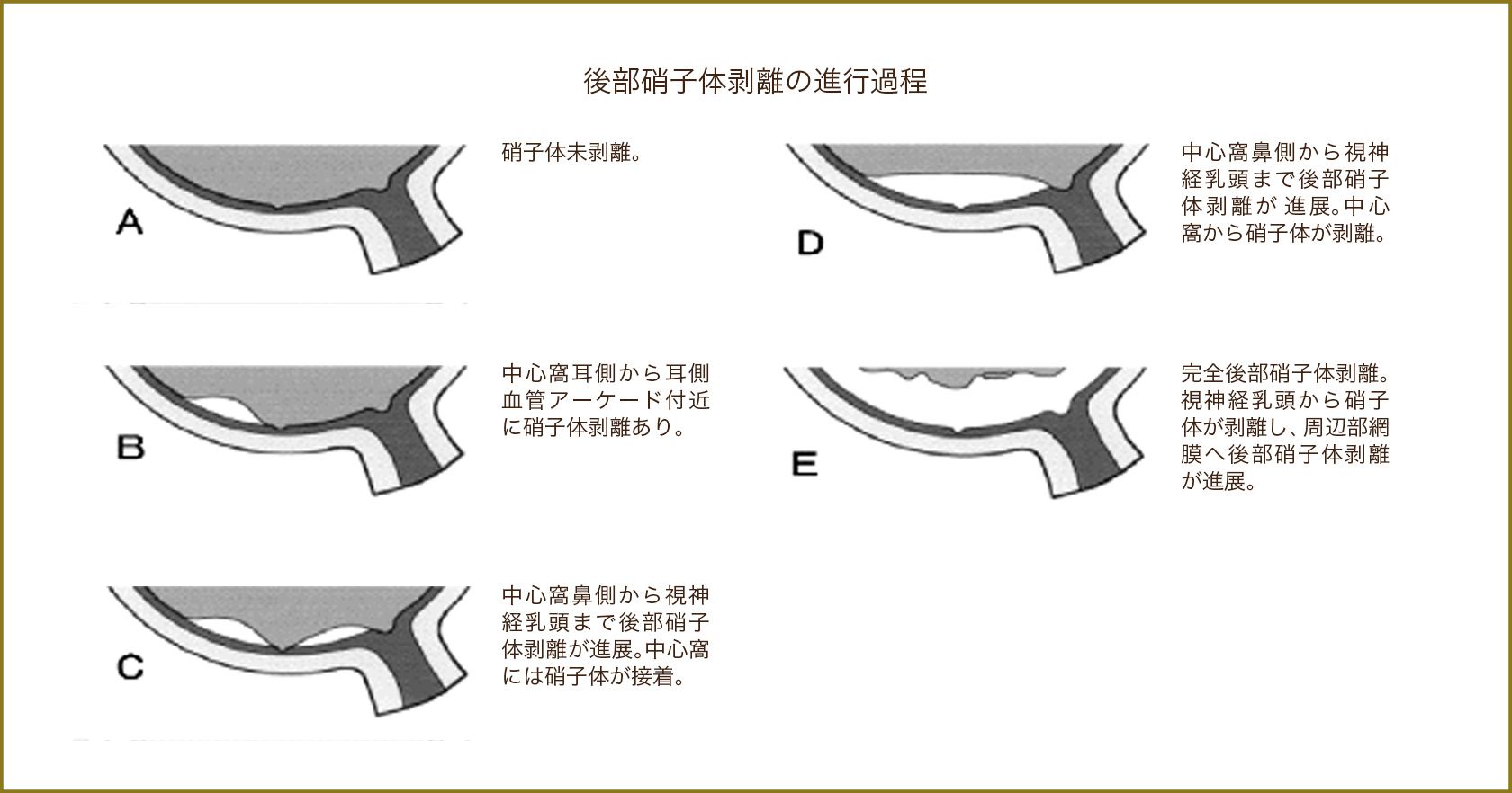 後部硝子体剥離の進行過程