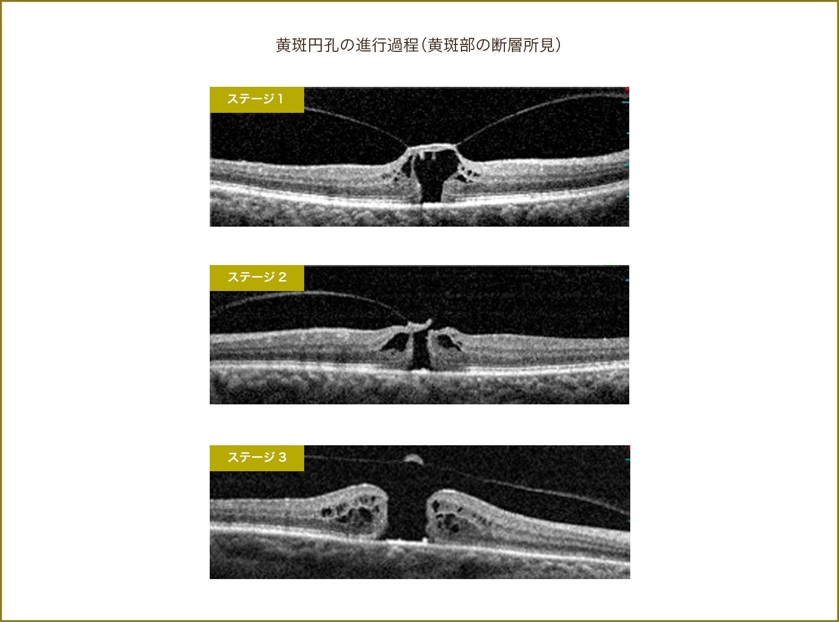 黄斑円孔の進行過程（黄斑部の断層所見）