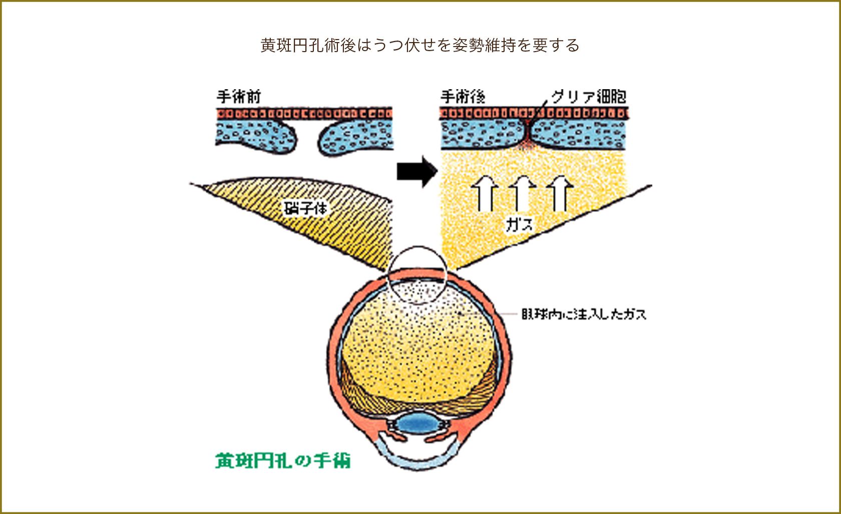 黄斑円孔術後はうつ伏せを姿勢維持を要する