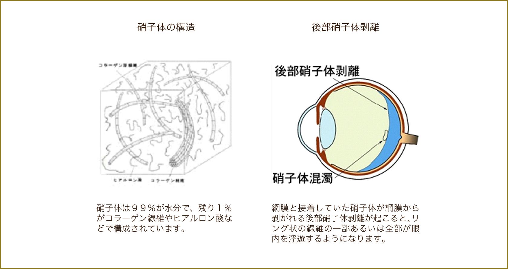 硝子体の構造,後部硝子体剥離