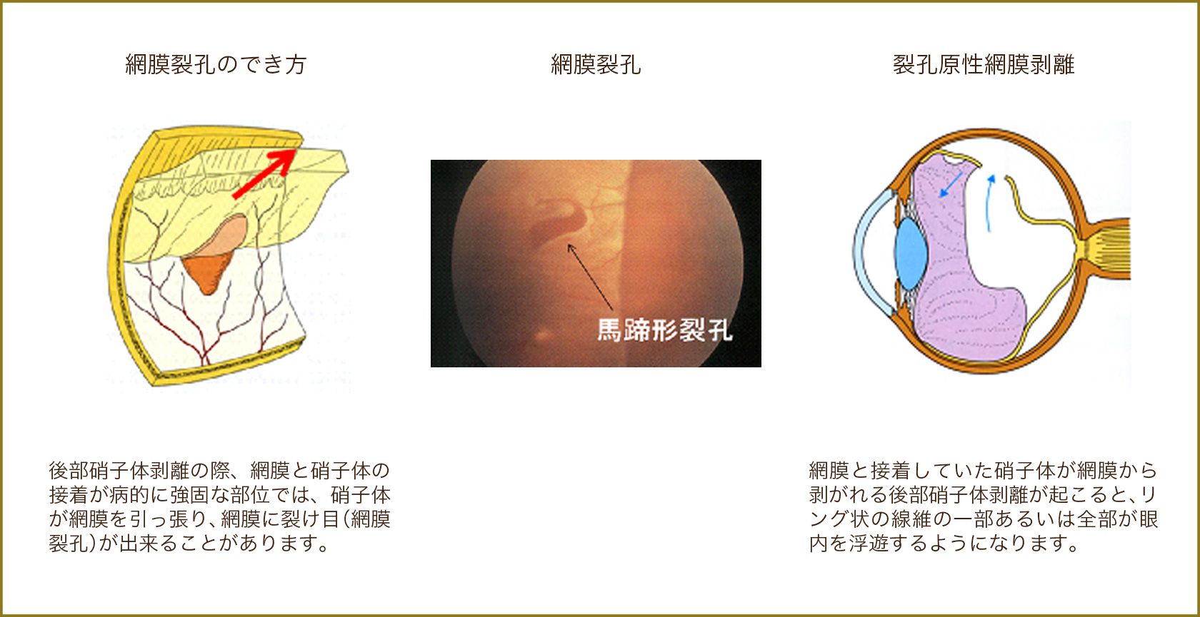 網膜裂孔のでき方,網膜裂孔,裂孔原性網膜剥離