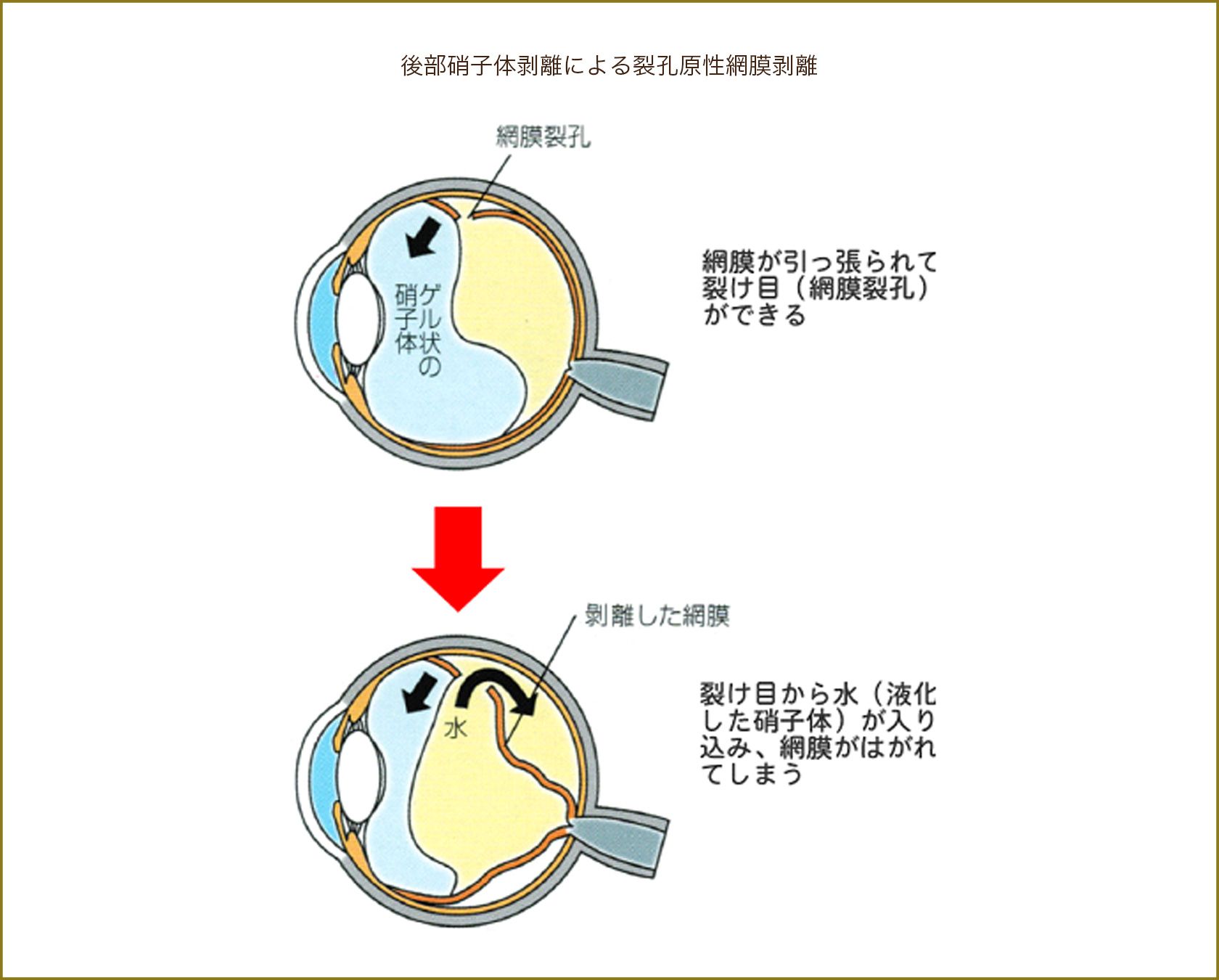 後部硝子体剥離による裂孔原性網膜剥離