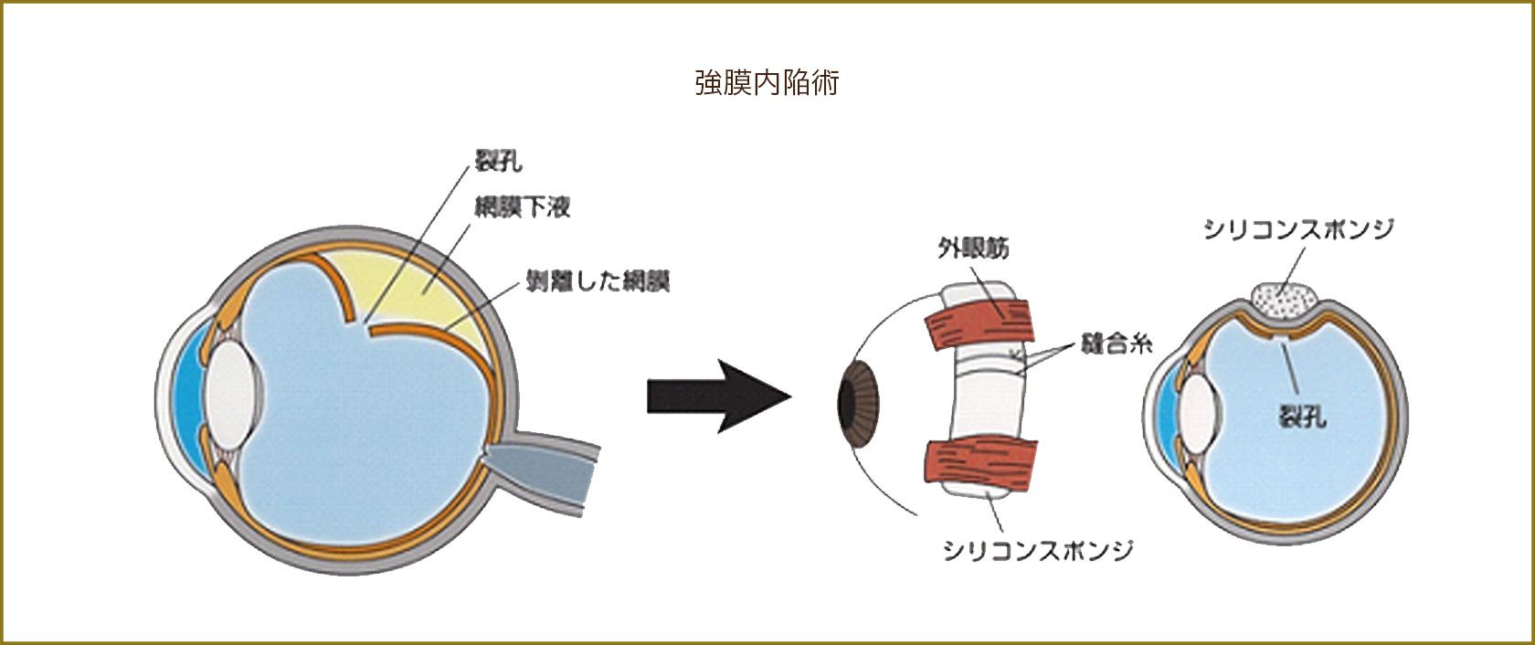 強膜内陥術