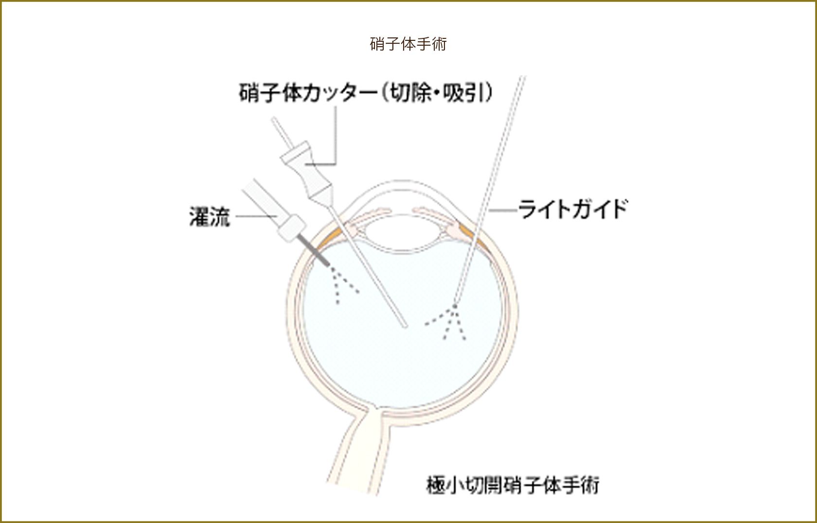 硝子体手術