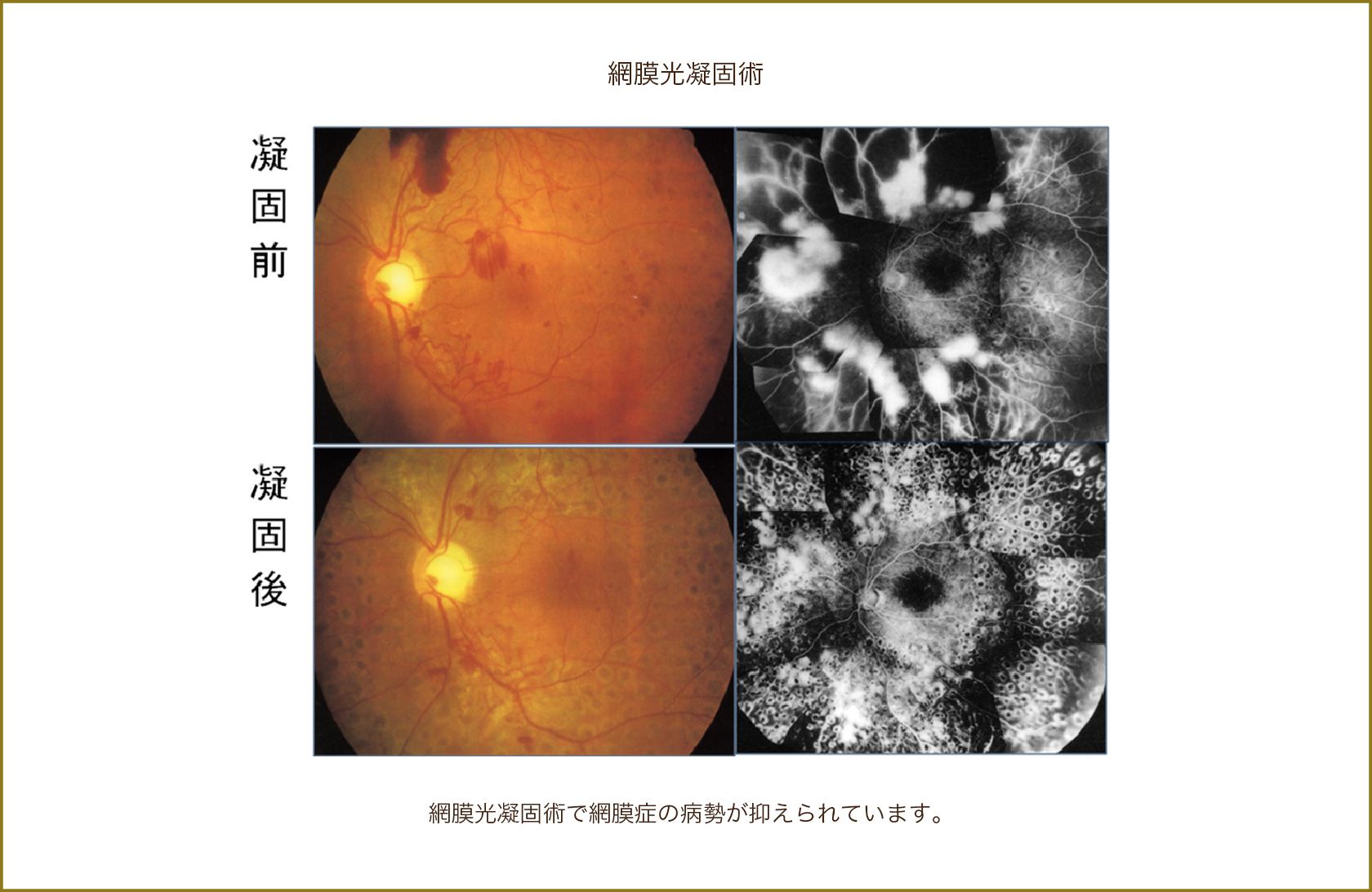 網膜光凝固術