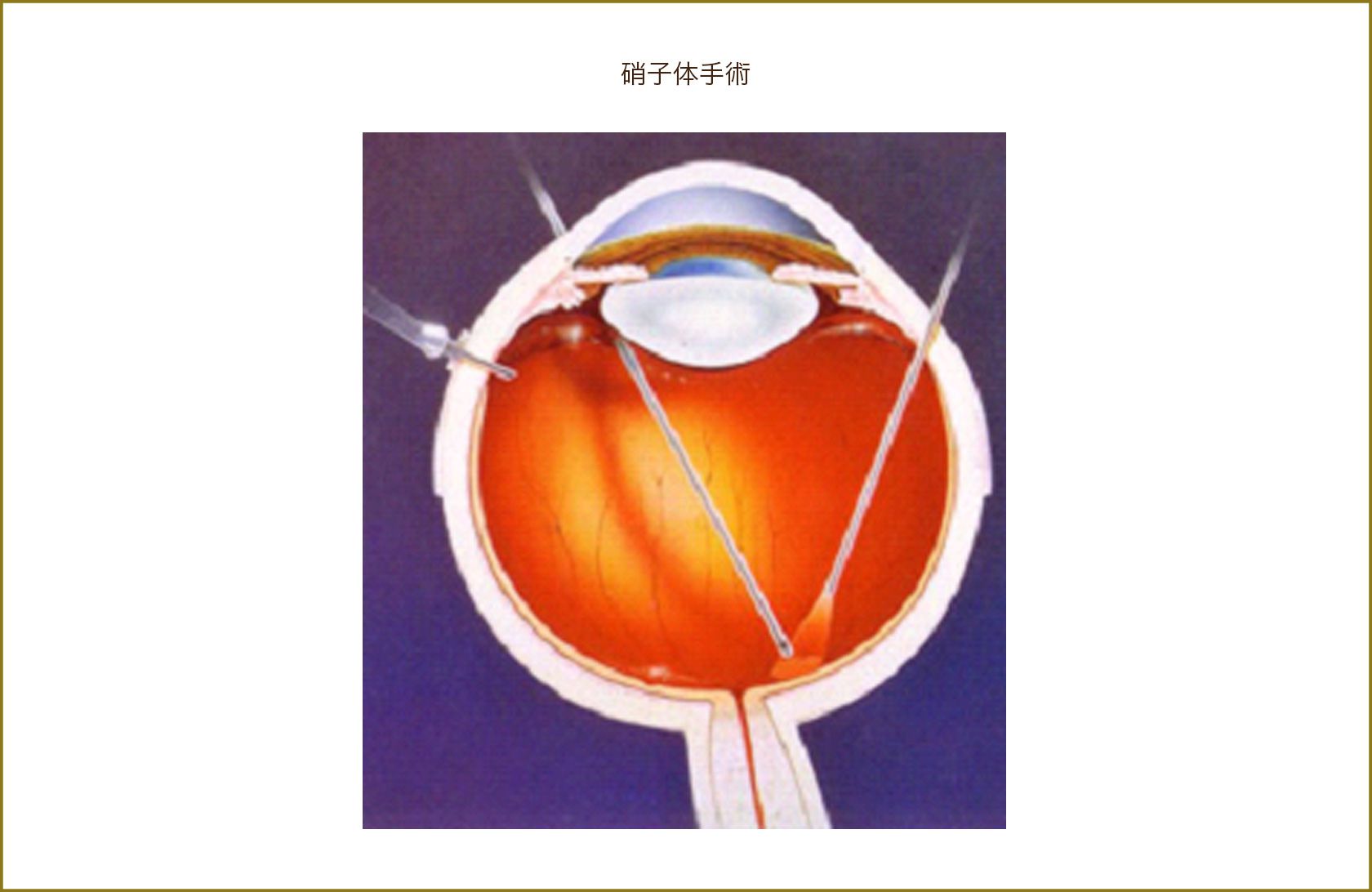 硝子体手術