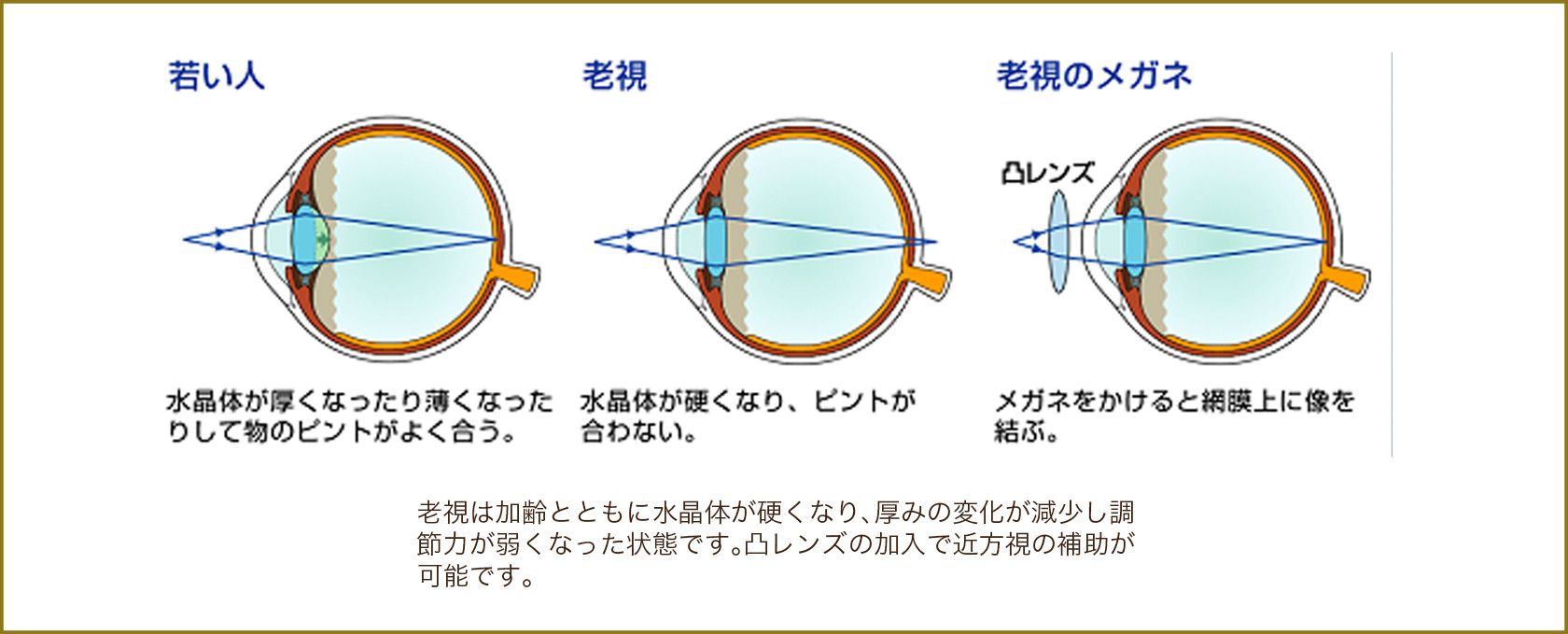 老視