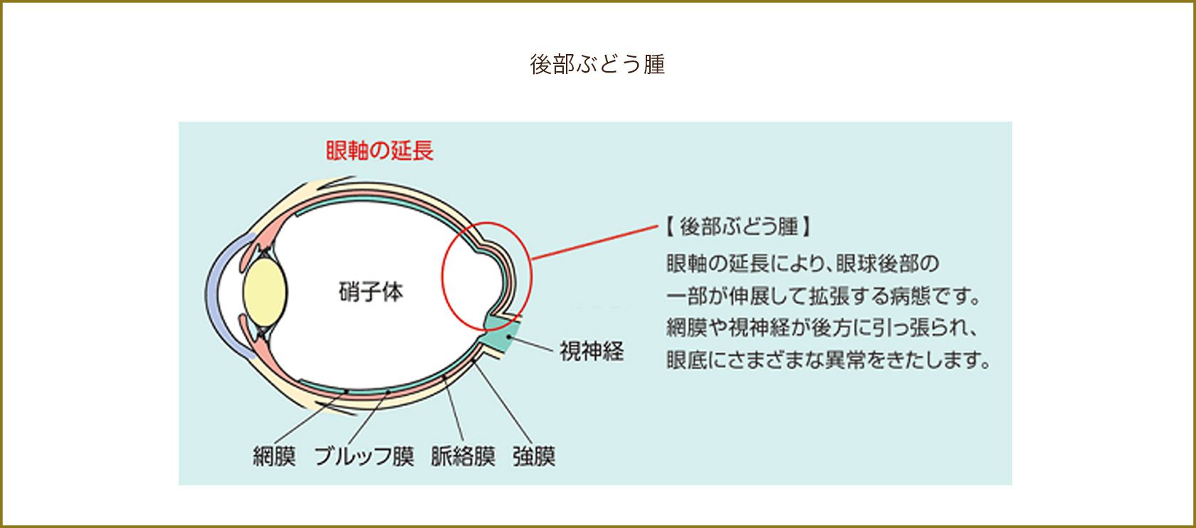 後部ぶどう腫