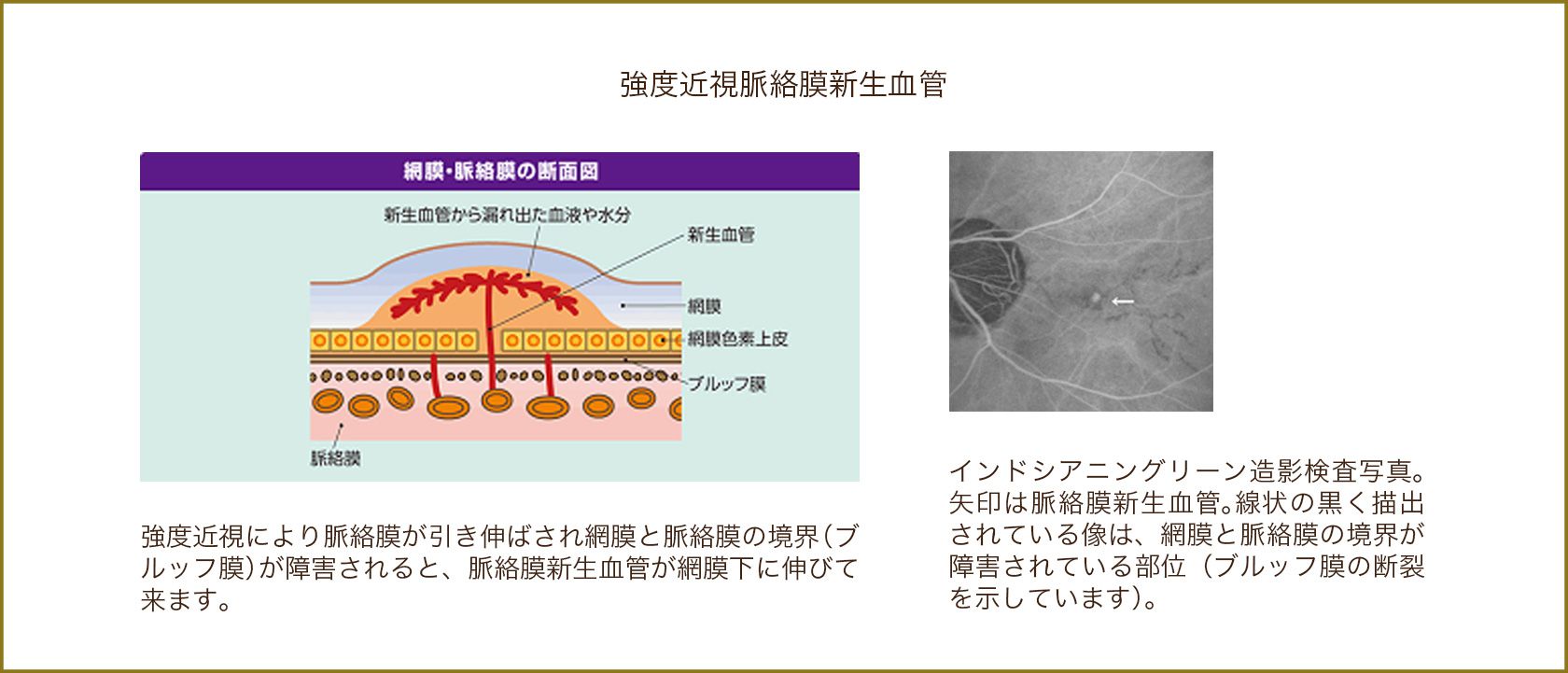 脈絡膜新生血管