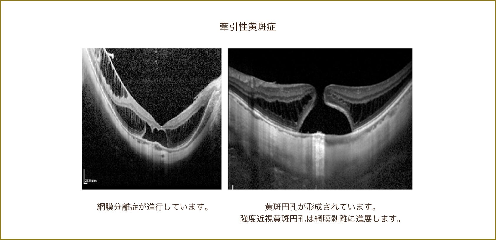 近視性牽引性黄斑症