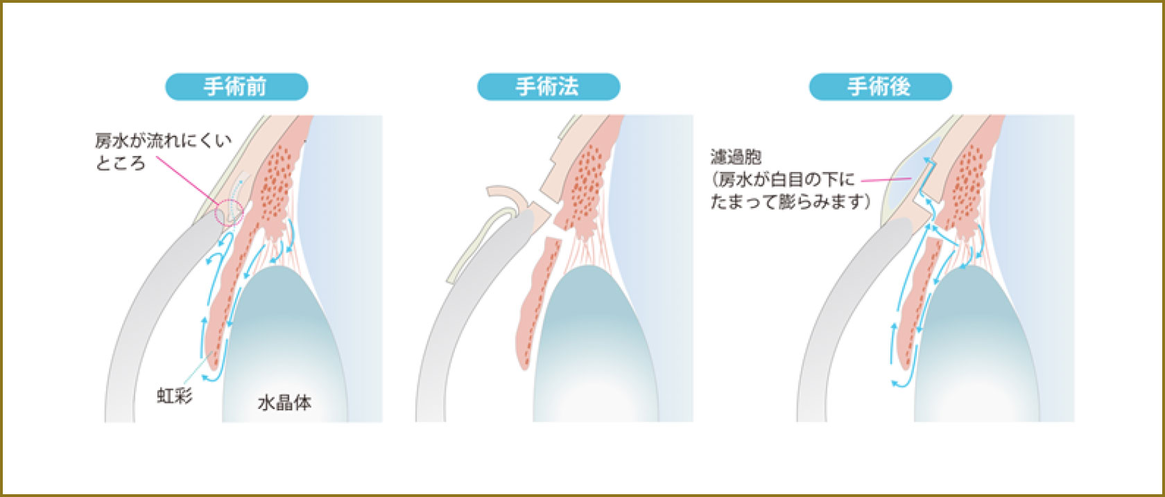 線維柱帯切除術（トラベクレクトミー）