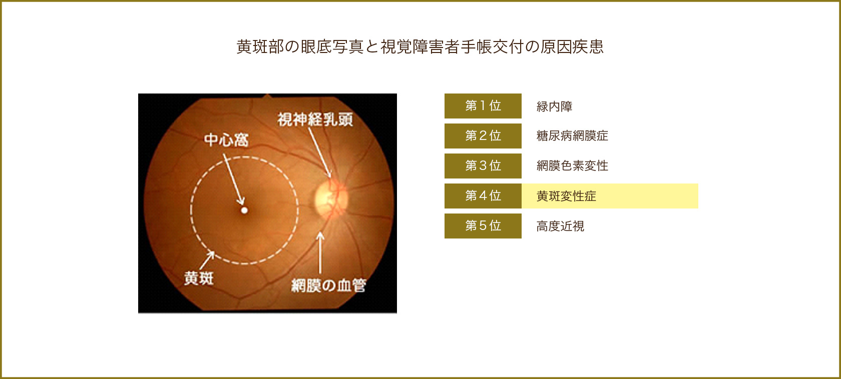 黄斑部の眼底写真と視覚障害者手帳交付の原因疾患