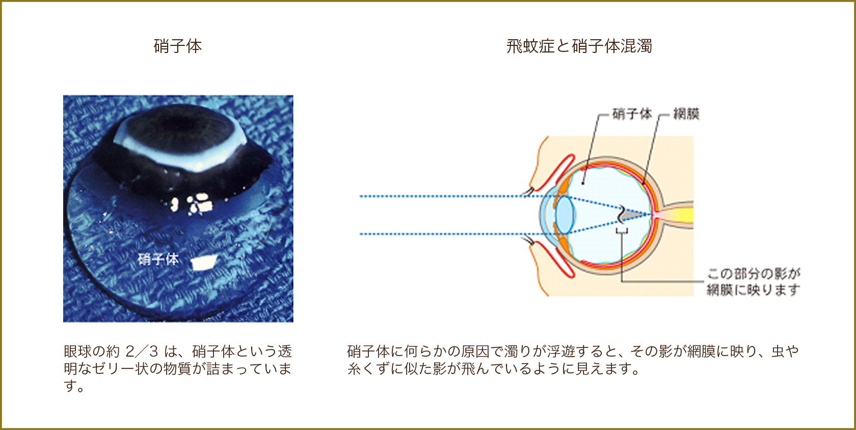 硝子体,飛蚊症と硝子体混濁