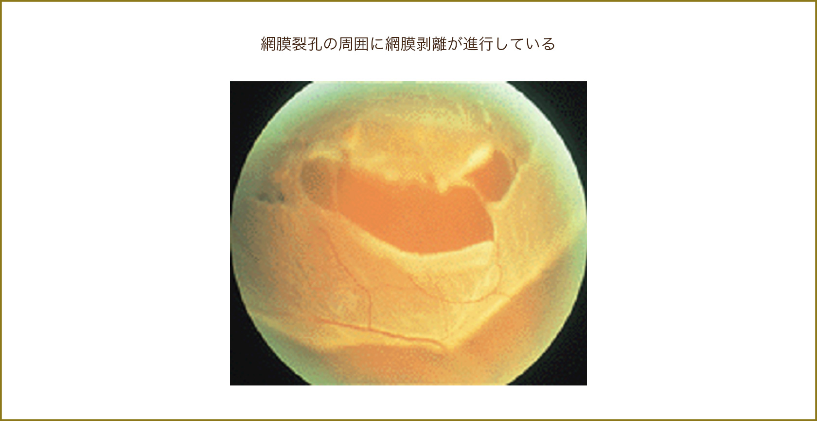 網膜裂孔の周囲に網膜剥離が進行している