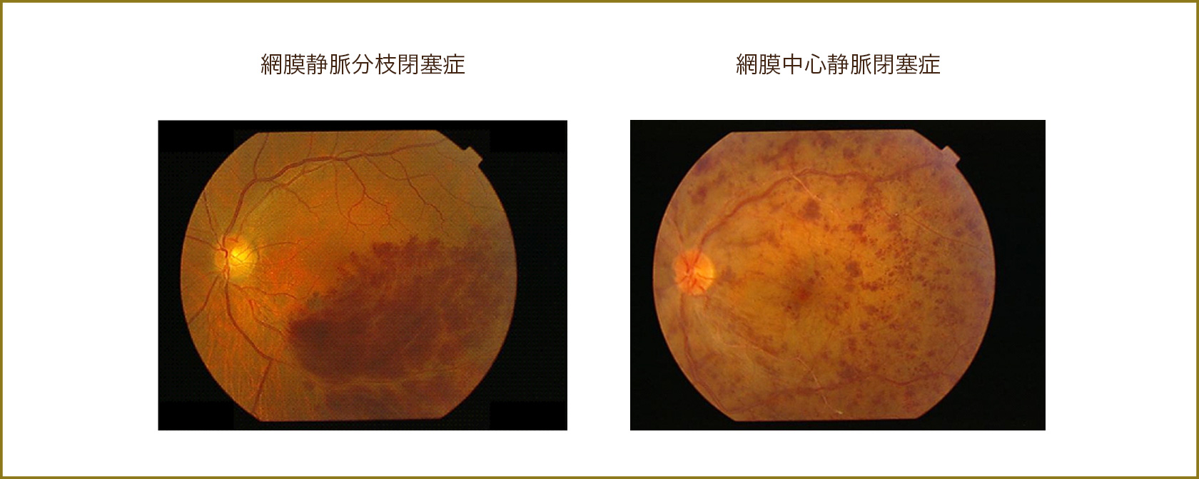 網膜静脈分枝閉塞症,網膜中心静脈閉塞症