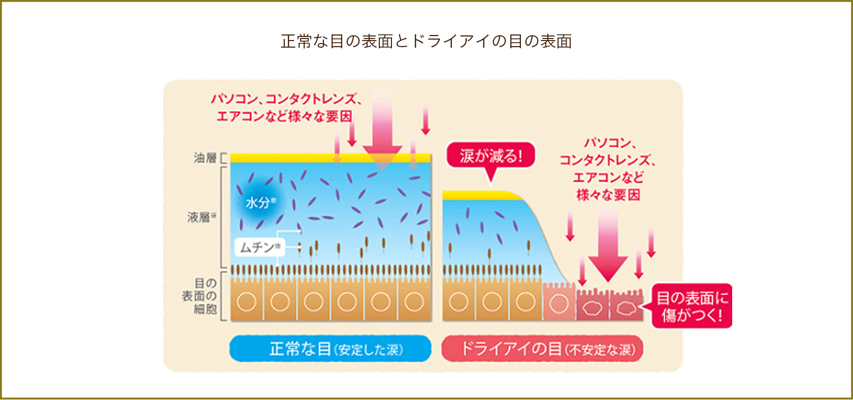 正常な目の表面とドライアイの目の表面